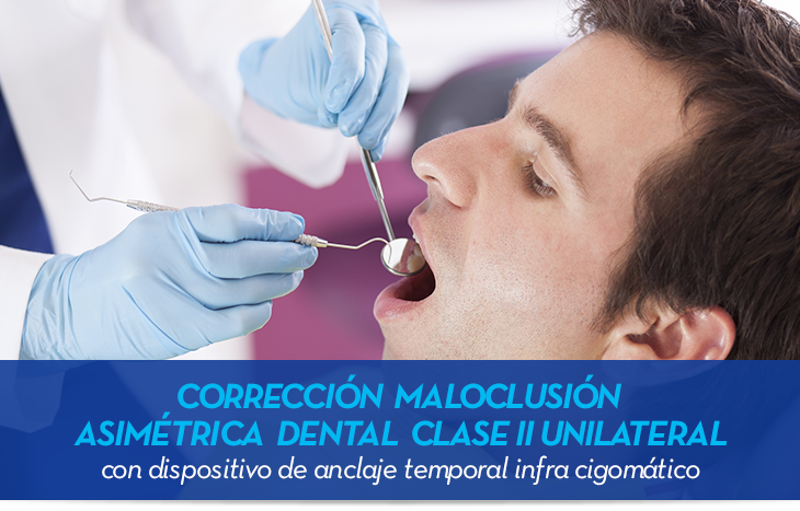 Corrección maloclusión asimétrica dental clase II unilateral con dispositivo de anclaje temporal infra cigomático