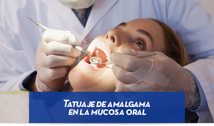Tatuaje de amalgama en la mucosa oral