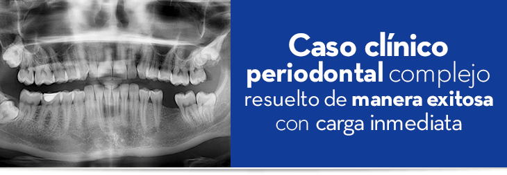 Caso clínico periodontal complejo resuelto de manera exitosa con carga inmediata